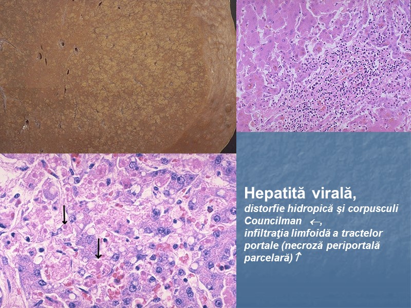 Hepatită virală, distorfie hidropică şi corpusculi  Councilman ,  infiltraţia limfoidă a tractelor
